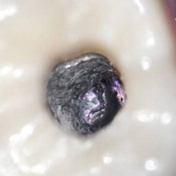 25x microscope progress image to expose the abutment screw