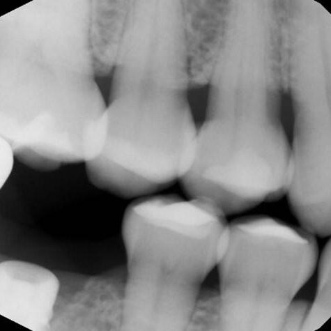 An Iatrogenic mechanical failure (1)