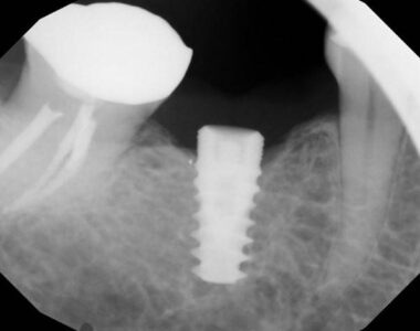 An Iatrogenic mechanical failure (2)