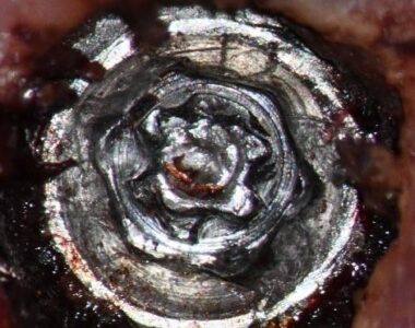 Preop. 25x clinical image. Note the previous eccentric recovery efforts on the screw and damage into the implant.