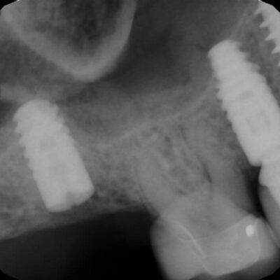 Preop radiograph from general dentist