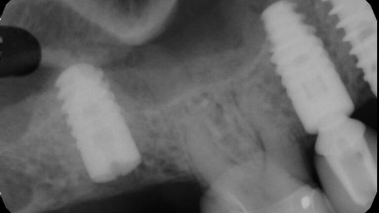 Preop radiograph from general dentist