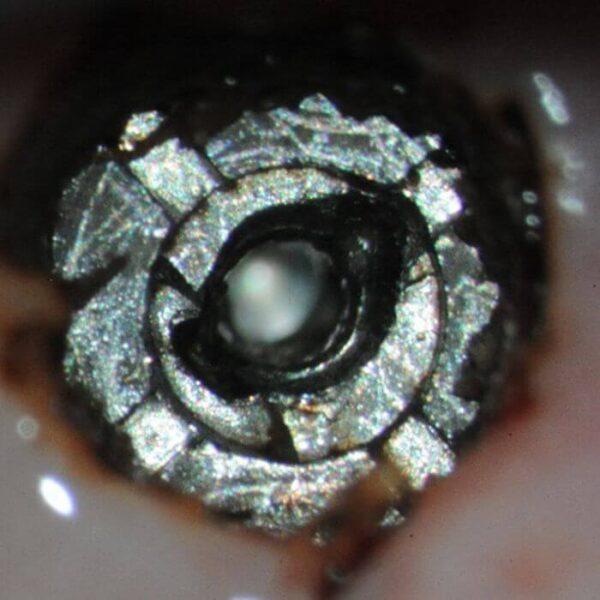 Preop image - note prior recovery attempt 2 and 8 o’clock