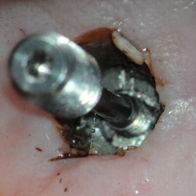 Distraction bolt placed