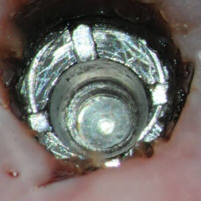 Implant clear – a focus stacked image