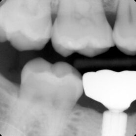 Preop. Radiograph from Dr. W. Preop. Radiograph from Dr. W.