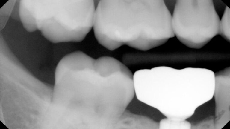 Preop. Radiograph from Dr. W.