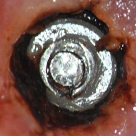 Preop. clinical post crown removal Preop. clinical post crown removal