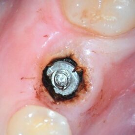 Overview of edentulous space Overview of edentulous space