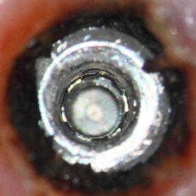 Postop implant clear Postop implant clear