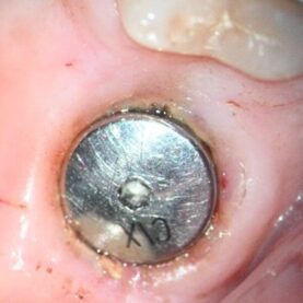 Healing abutment placed Healing abutment placed