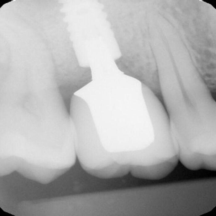 Preop radiograph Preop radiograph