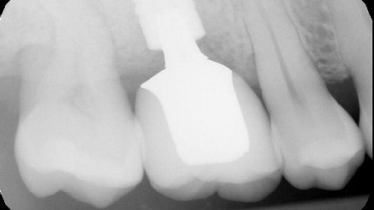 Preop radiograph