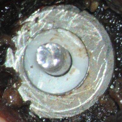 Abutment screw head removed with the crew shaft rotated up