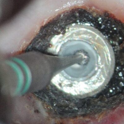 Thinning zirconia conus 1