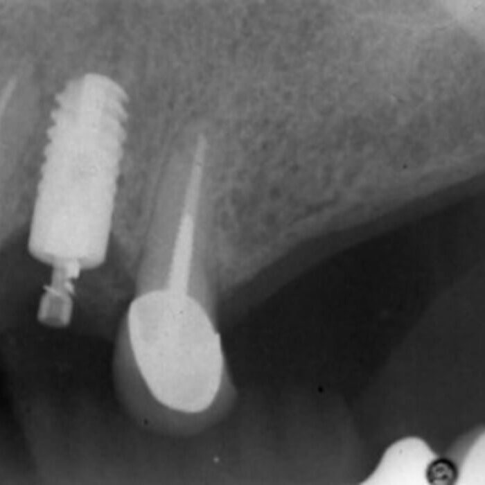 Ankylos fractured Zirconia Abutment-1 Preoperative radiograph