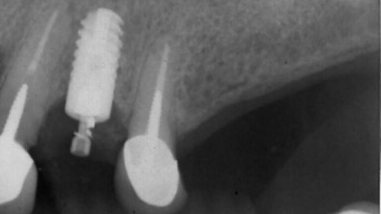 Preoperative radiograph