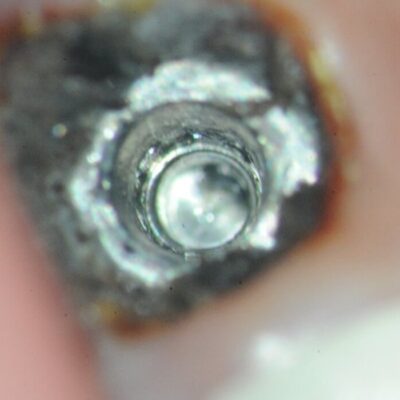 Ankylos fractured Zirconia Abutment-2 Implant clear of zirconia abutment and screw fragments