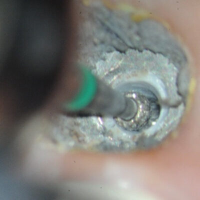 Ankylos fractured Zirconia Abutment-4 Further thinning of the zirconus wall