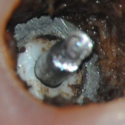 Ankylos fractured Zirconia Abutment-7 Head of the abutment screw removed