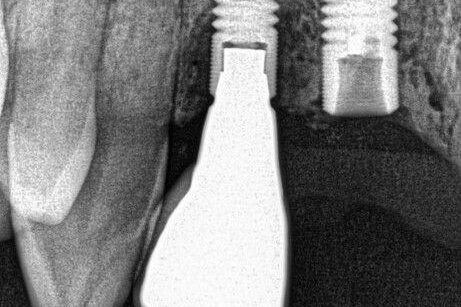 IMR attempt without microscope