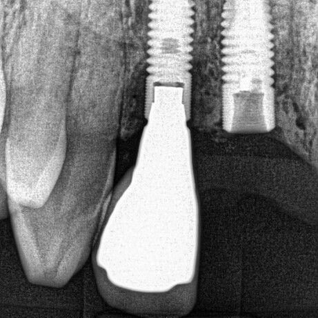 IMR attempt without microscope IMR attempt without microscope