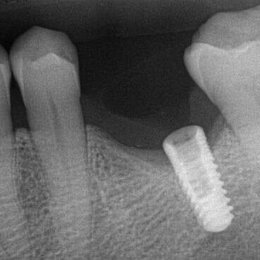 Case 0040 Iatrogenic Screw Retrieval image003 Case 0040 Iatrogenic Screw Retrieval image003