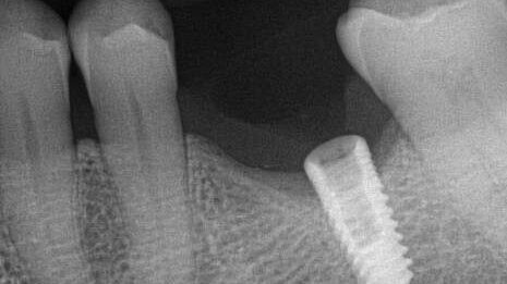 Case 0040 Iatrogenic Screw Retrieval image003