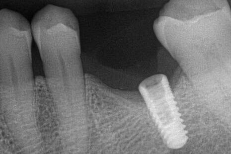 Case 0040 Iatrogenic Screw Retrieval image003