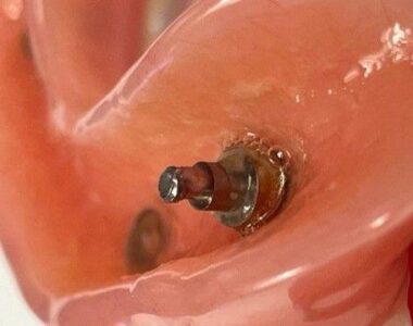 Intaglio of fractured #27                     abutment in the overdenture supplied preop by the patient