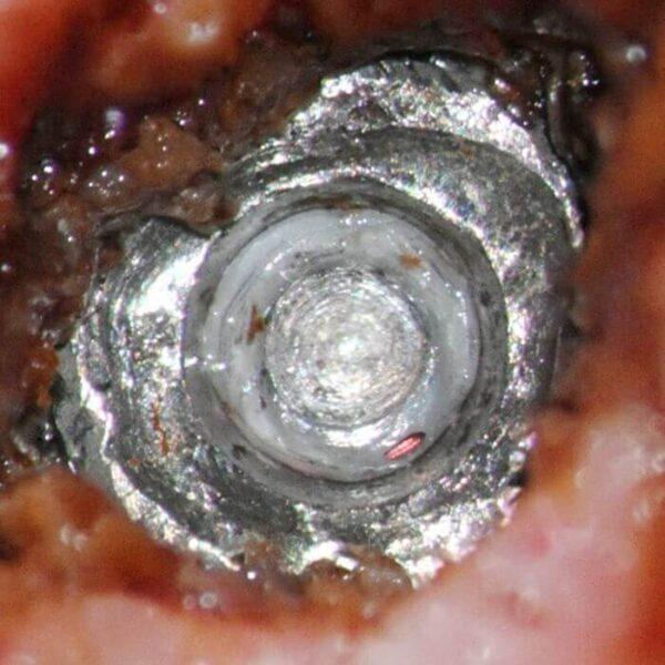 Preop exposed implant top #1 Note: troughing of the implant top which reduces the area of the conical connection