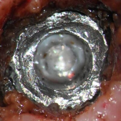 Preop exposed implant top #2