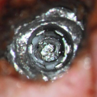 Conus reduced to top of splines