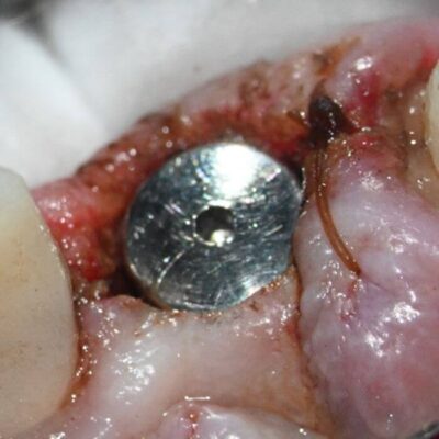 Healing abutment placed