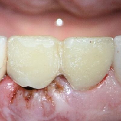 Provisional replaced