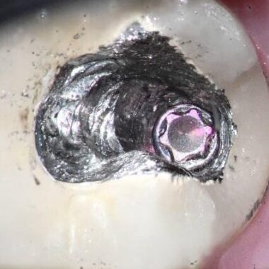 Significant lingual crown wall was removed to gain access to the screw.