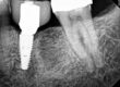 IMR Case Study Another Fractured TiBase abutment (1)