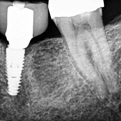 IMR Case Study Another Fractured TiBase abutment (1) IMR Case Study Another Fractured TiBase abutment (1)