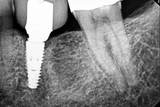 IMR Case Study Another Fractured TiBase abutment (1)