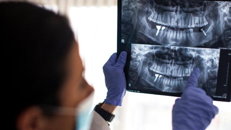 Broken Implant Pre-appointment Preparation Mastrovich Dental