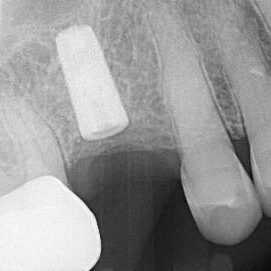 Prior Eccentric Free Hand Drilling Case 0041 (21)