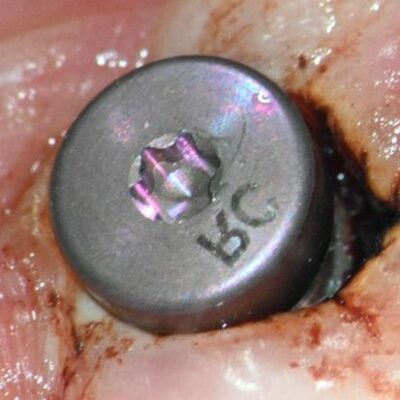 Retrieval_of_a_fractured_Straumann_Healing_Abutment_Post_Ultrasonic_Attempt_Healing_abutemnt Healing abutment placed