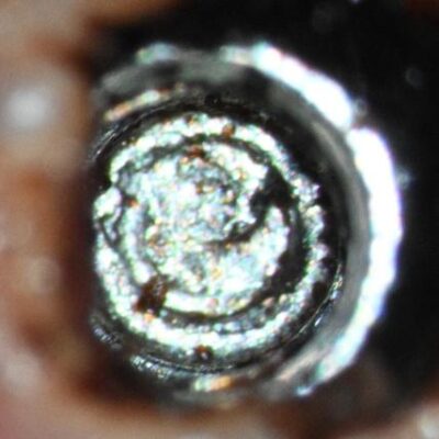 Retrieval_of_a_fractured_Straumann_Healing_Abutment_Post_Ultrasonic_Attempt_Preop_clinical_1 Preop clinical at 25x magnifacation. Note the smeared appearance of the fragment-implant junction. This is secondary to ultrasonic