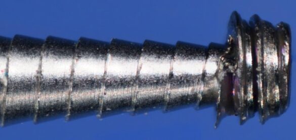 Retrieval_of_a_fractured_Straumann_Healing_Abutment_Post_Ultrasonic_Attempt_Recovered_Gragment Recovered fragment on the .8mm screw extractor