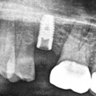 Salvin screw recovery kit – Groat Case 0034 (1)