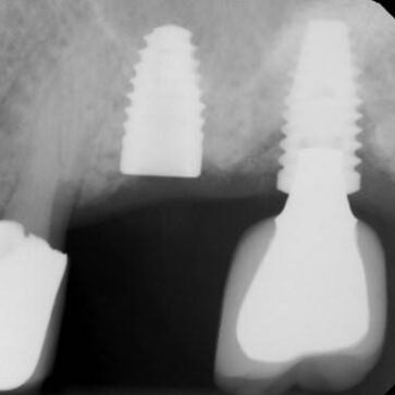 Ultrasonic thread damage Bufty Case 0033 (1) Preop radiograph from the referring office