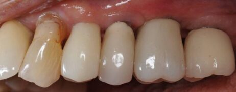 Ultrasonic thread damage Bufty Case 0033 (5) Intraoral postop images of the seated case