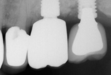 Ultrasonic thread damage Bufty Case 0033 (7) Postop baseline PA