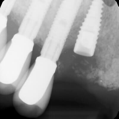 Preop images from the restorative Dr. of #6 and #9 Preop images from the restorative Dr. of #6 and #9