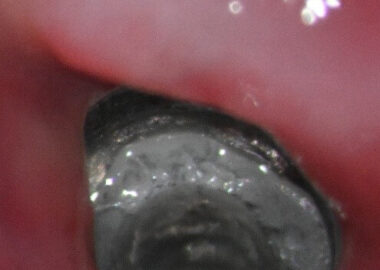 3 Preop clinical views of the zirconia fragment and in the right 2 images the reflection at 12:00 and 1:00 are implant defects from zirconia drilling 3 Preop clinical views of the zirconia fragment and in the right 2 images the reflection at 12:00 and 1:00 are implant defects from zirconia drilling